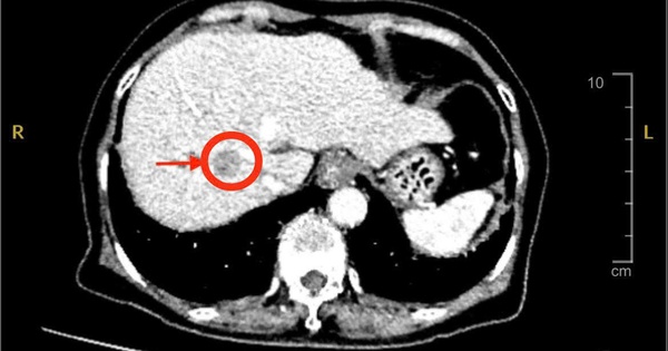 Đau bụng nhẹ, đi khám phát hiện ung thư gan