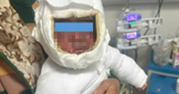 Kéo dây điện ấm đun nước siêu tốc, bé trai bị bỏng nặng