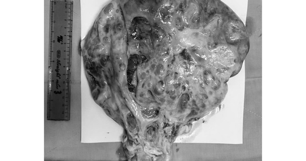 Mổ nội soi lấy khối u nặng hơn 6 kg cho nữ bệnh nhân ở Vĩnh Long