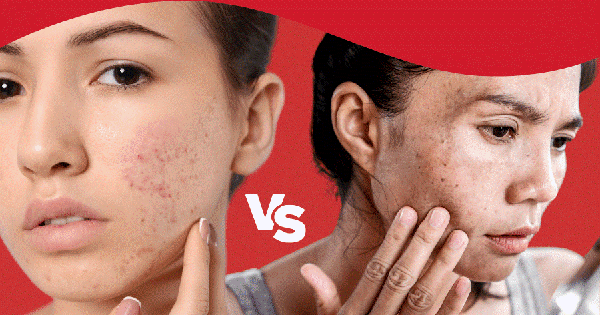 Hết thâm đỏ sau mụn nhanh: Cách chọn sản phẩm chuẩn khoa học