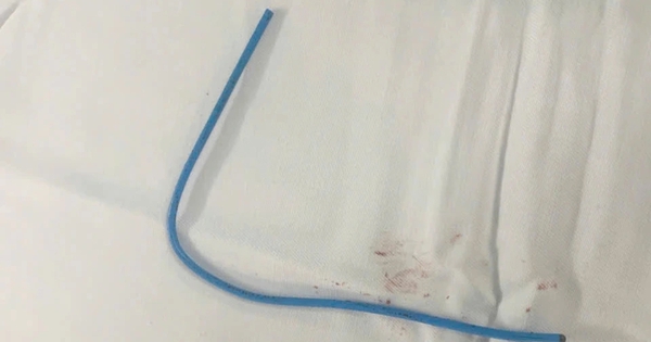 Bệnh viện Quân y 175 tiếp nhận ca bệnh bị dị vật kẹt trong tim hiếm gặp