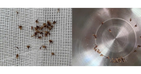 Gắp ra gần 50 v&ograve;i ong từ cơ thể người đ&agrave;n &ocirc;ng