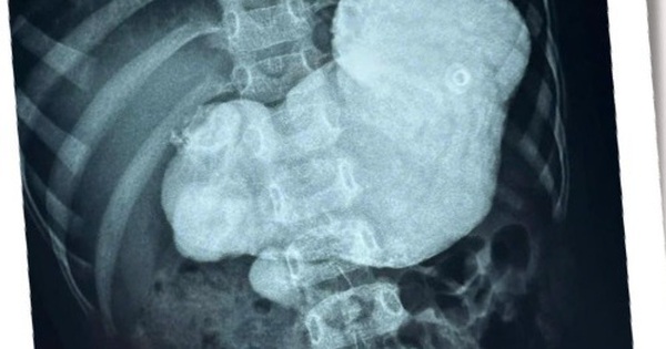 Ruột non b&eacute; trai bị xoắn 720 độ, phải mổ khẩn cấp nhằm tr&aacute;nh hoại tử