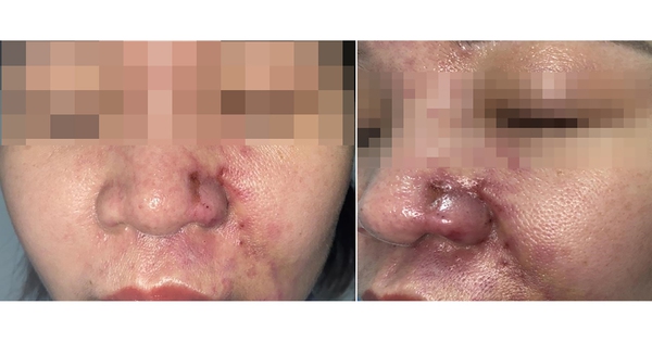 M&ugrave; mắt, tắc mạch, nhiễm tr&ugrave;ng, hoại tử da do l&agrave;m đẹp kh&ocirc;ng an to&agrave;n