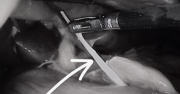 Thủng dạ d&agrave;y do nuốt xương c&aacute; trong l&uacute;c ăn lẩu