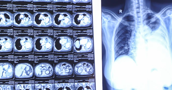 Cứu bệnh nh&acirc;n bị ph&igrave;nh động mạch phổi phức tạp