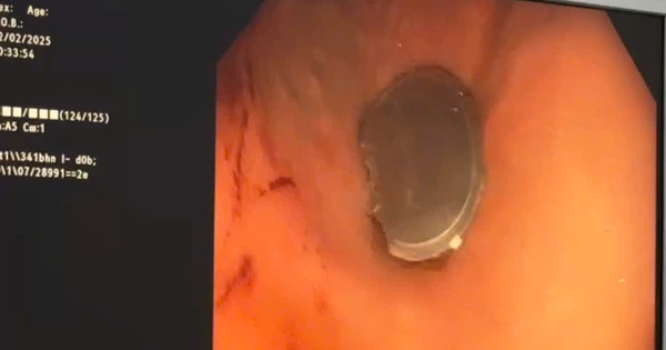 B&eacute; trai 11 tuổi nuốt nắp lon nước ngọt g&acirc;y chảy m&aacute;u thực quản