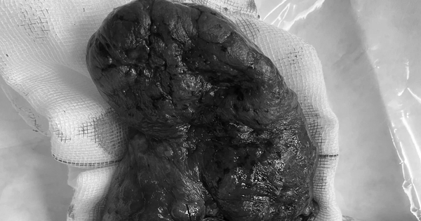 Nhập viện do ti&ecirc;u chảy, t&igrave;nh cờ b&aacute;c sĩ ph&aacute;t hiện ung thư phổi