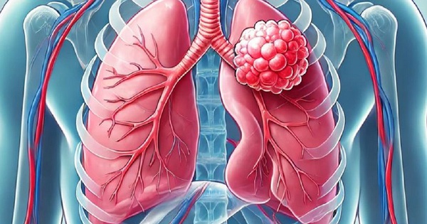 V&igrave; sao ung thư hay di căn đến phổi?