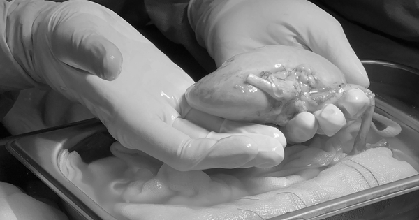 Gh&eacute;p thận - th&agrave;nh tựu y khoa nổi bật tại miền T&acirc;y