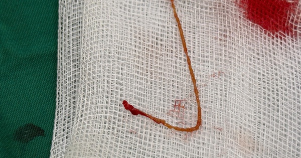 Người phụ nữ bị sỏi t&uacute;i mật v&agrave; &aacute;p xe gan do nhiễm giun s&aacute;n