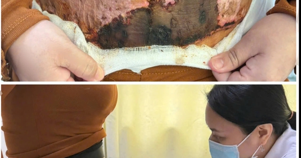 Hoại tử da bụng sau h&uacute;t mỡ theo quảng c&aacute;o tr&ecirc;n mạng x&atilde; hội