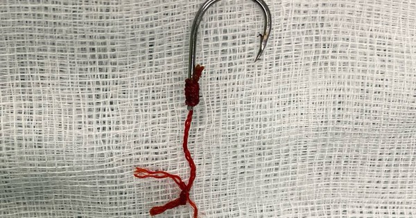 Lưỡi c&acirc;u mắc ở hậu m&ocirc;n bệnh nh&acirc;n, nghi do ăn bao tử c&aacute;