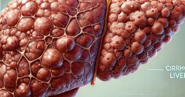 Ng&agrave;y mới với tin tức sức khỏe: Nguy&ecirc;n nh&acirc;n bất ngờ c&oacute; thể g&acirc;y xơ gan