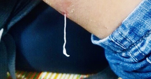 C&aacute;c thực phẩm c&oacute; nguy cơ g&acirc;y nhiễm giun rồng