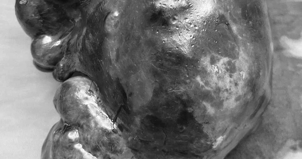 Cắt bỏ khối u nang l&aacute;ch nặng 1,3 kg, to gấp 40 lần b&igrave;nh thường