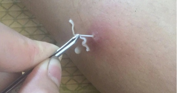 Bệnh giun rồng c&oacute; nguy hiểm kh&ocirc;ng?