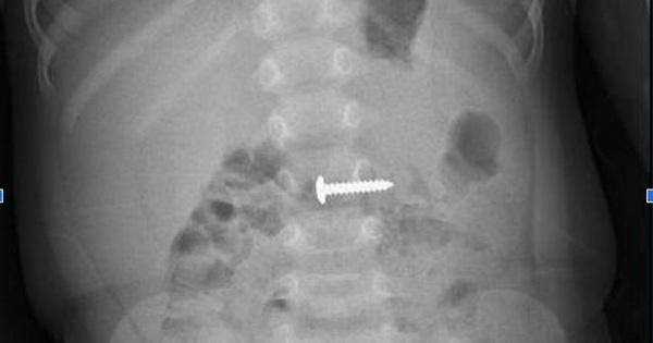 Cứu ch&aacute;u b&eacute; nuốt phải c&acirc;y đinh v&iacute;t sắc nhọn