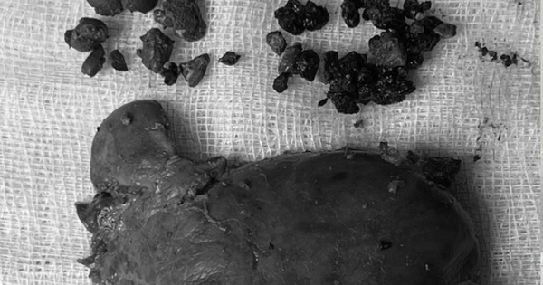 Ngứa khắp người hơn 2 năm, kh&aacute;m sức khỏe ph&aacute;t hiện xơ gan, sỏi đường mật