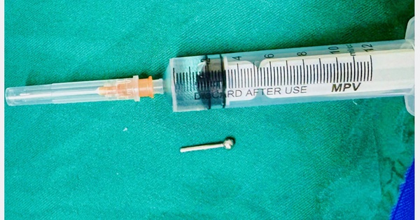 C&ocirc; g&aacute;i nuốt chiếc khuy&ecirc;n lưỡi khi ăn bữa tối