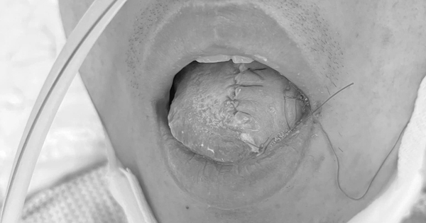 T&aacute;i tạo lưỡi cho nam thanh ni&ecirc;n mắc ung thư lưỡi