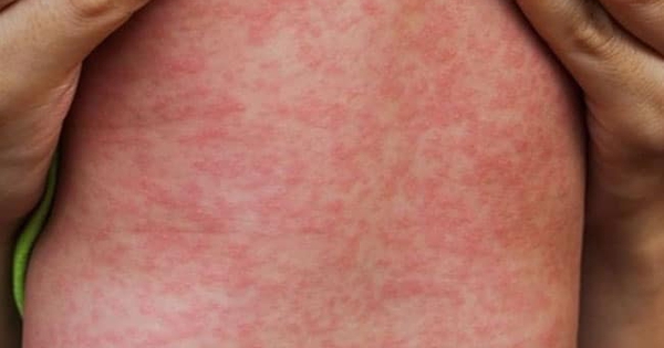 4 nh&oacute;m triệu chứng cảnh b&aacute;o bệnh sởi tăng nặng