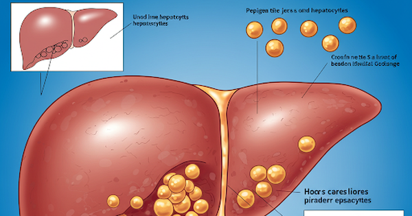 Ng&agrave;y mới với tin tức sức khỏe: Bệnh gan nhiễm mỡ nguy hiểm thế n&agrave;o?