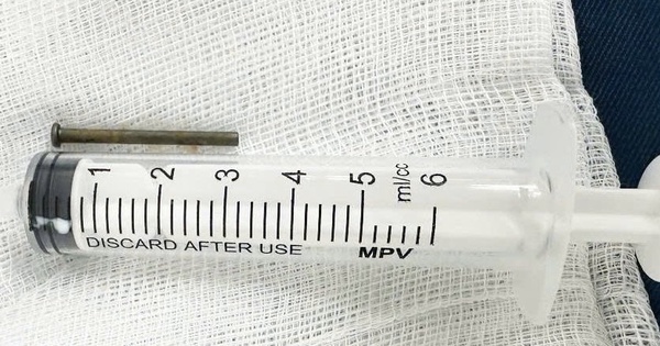 B&eacute; trai 6 tuổi ở Quảng Ng&atilde;i tho&aacute;t nguy hiểm nhờ được gắp đinh sắt trong bụng