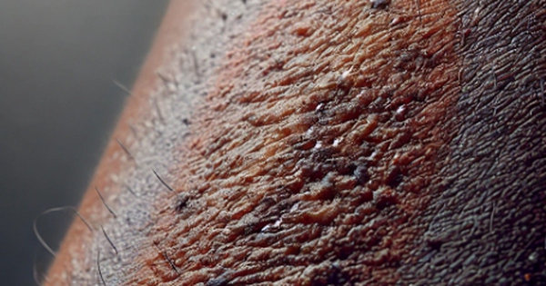 Ng&agrave;y mới với tin tức sức khỏe: Dấu hiệu tr&ecirc;n da cảnh b&aacute;o bệnh tiểu đường