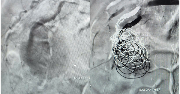 Bị ng&atilde; hơn 1 th&aacute;ng, tiểu ra m&aacute;u mới ph&aacute;t hiện chấn thương thận rất nặng