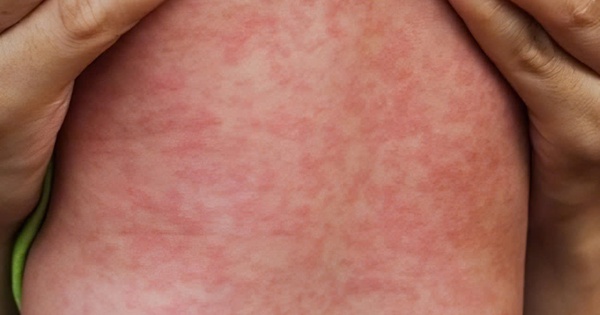 Cảnh b&aacute;o nh&oacute;m nguy cơ cao bị biến chứng nặng do sởi