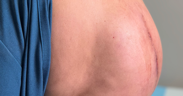 Rạch khối u, h&uacute;t 2 l&iacute;t dịch mủ từ lưng người phụ nữ