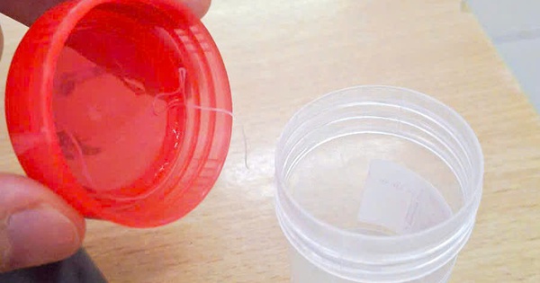 K&yacute; sinh tr&ugrave;ng 10 cm sống trong mắt bệnh nh&acirc;n