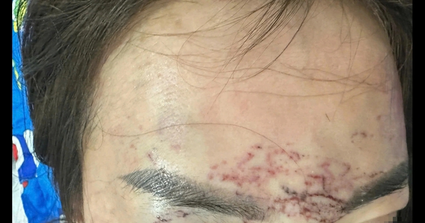 C&agrave; Mau: Một phụ nữ tố bị bắt, đ&aacute;nh đập, xăm mặt, tạt axit v&igrave; ghen