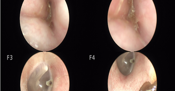 &Ugrave; tai, nghe k&eacute;m, đi kh&aacute;m ph&aacute;t hiện lồi xương ống tai hiếm gặp