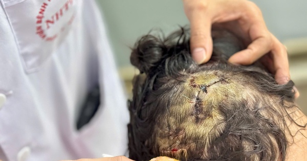 Nguy cơ nhiễm virus dại từ ch&oacute; nh&agrave; nu&ocirc;i