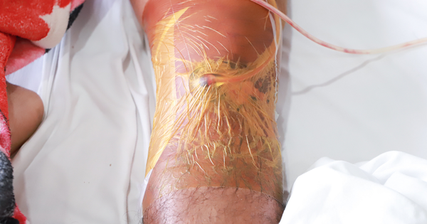 Đau nhức gối, nhập viện ph&aacute;t hiện bị &#039;vi khuẩn ăn thịt người&#039; tấn c&ocirc;ng