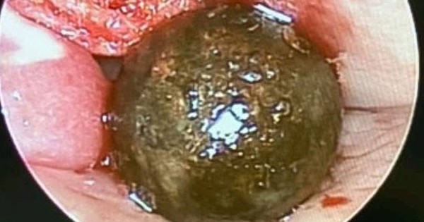 Vi&ecirc;n đạn bắn chim nằm trong hốc mũi b&eacute; trai suốt 5 năm