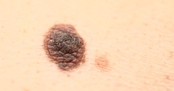 Su&yacute;t mất b&agrave;n ch&acirc;n do bị bỏ qua x&eacute;t nghiệm ung thư &#039;nốt ruồi&#039; đen