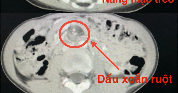 B&oacute;c t&aacute;ch khối u &#039;khủng&#039; cho b&eacute; trai 8 tuổi tho&aacute;t nguy cơ hoại tử ruột