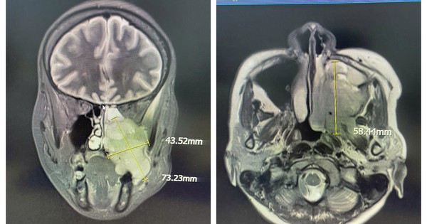 Đau hàm, nghẹt mũi, chảy máu răng - Đi khám phát hiện ung thư xoang