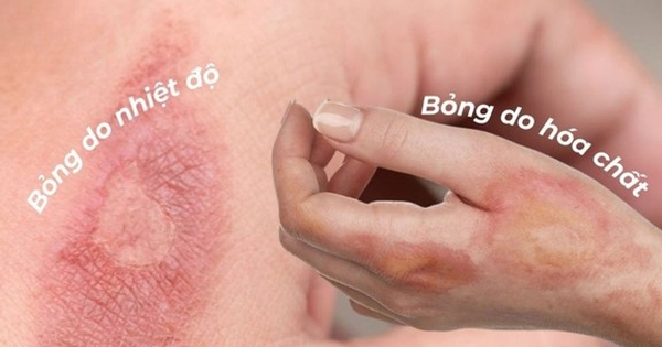 Cứ nghĩ sẹo bỏng phải xâm lấn nhưng dùng kem mờ sẹo vẫn hiệu quả nhanh chóng