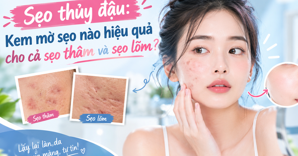 Sẹo thủy đậu: Kem mờ sẹo nào hiệu quả cho cả sẹo thâm và sẹo lõm?