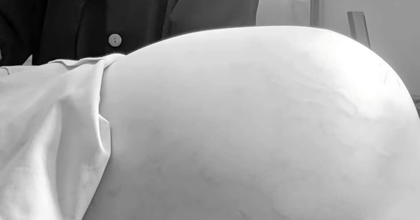 Bệnh viện Nhi đồng 1 TP.HCM mổ bướu buồng trứng 15 kg ở bé gái 14 tuổi