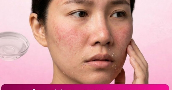 Cần làm gì sau khi peel da? Bất ngờ 99% đều làm sai khiến da tổn thương