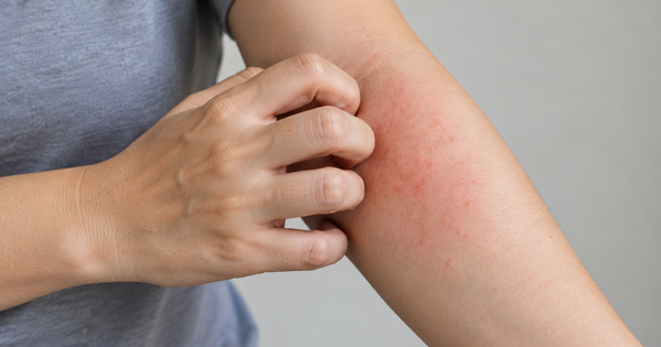 Vì sao người chạy thận nhiều năm bị ngứa da, đau nhức xương khớp?