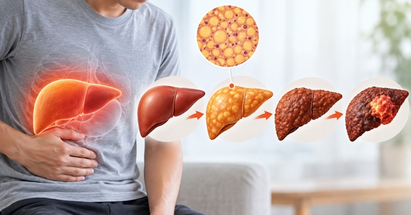 Gan nhiễm mỡ: Khi nào nguy cơ ung thư gan tăng cao?
