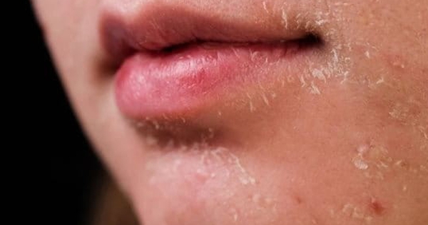 Da dầu mụn bóng dầu lại khô căng: Lý do khiến nhiều người ngỡ ngàng không tin