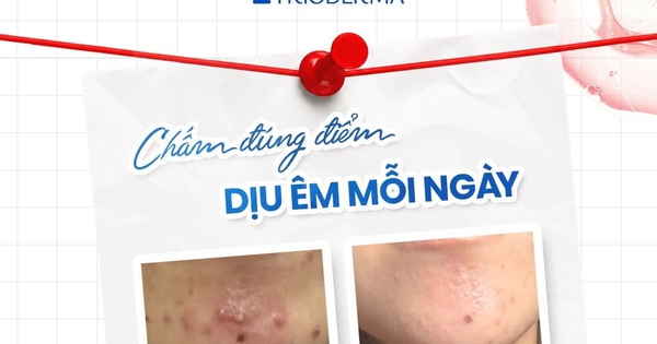Mụn viêm sưng đỏ: Chấm gì vừa giúp xẹp mụn sau khoảng 1 đêm vừa ngừa sẹo?