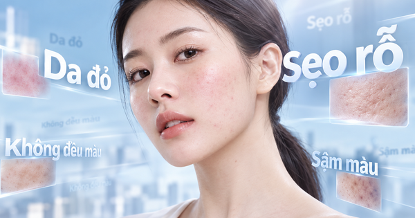 Sẹo rỗ nông sau mụn: Chăm sóc thế nào để bề mặt da trông mịn màng hơn?